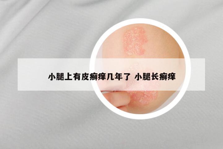 小腿上有皮癣痒几年了 小腿长癣痒