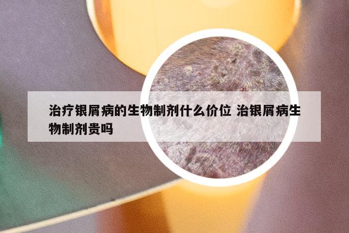治疗银屑病的生物制剂什么价位 治银屑病生物制剂贵吗