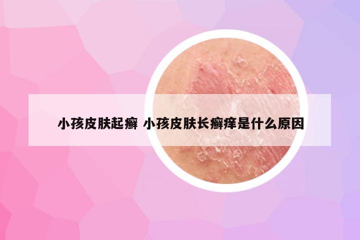 小孩皮肤起癣 小孩皮肤长癣痒是什么原因