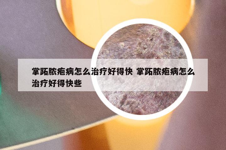 掌跖脓疱病怎么治疗好得快 掌跖脓疱病怎么治疗好得快些