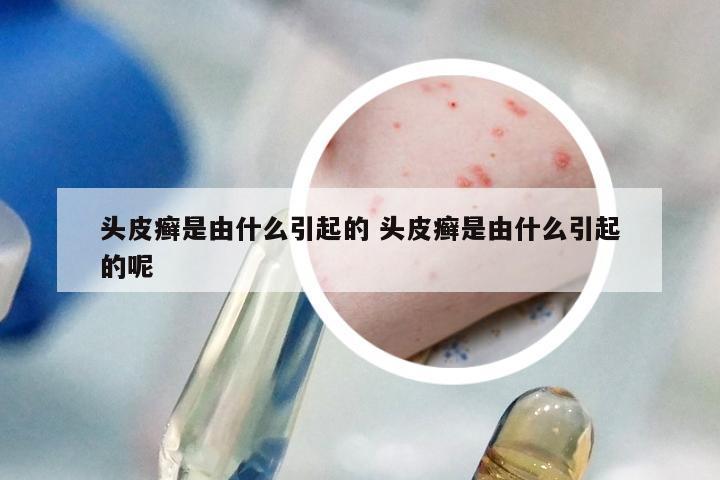 头皮癣是由什么引起的 头皮癣是由什么引起的呢