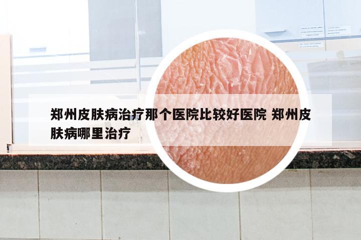 郑州皮肤病治疗那个医院比较好医院 郑州皮肤病哪里治疗