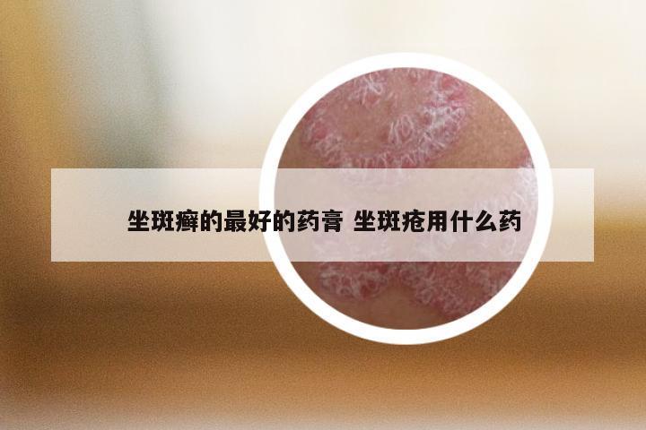 坐斑癣的最好的药膏 坐斑疮用什么药