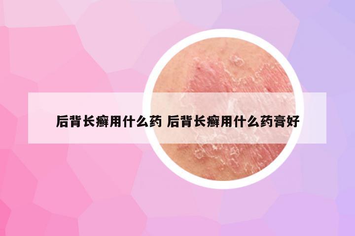 后背长癣用什么药 后背长癣用什么药膏好