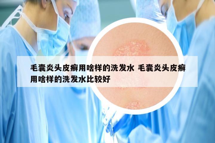 毛囊炎头皮癣用啥样的洗发水 毛囊炎头皮癣用啥样的洗发水比较好