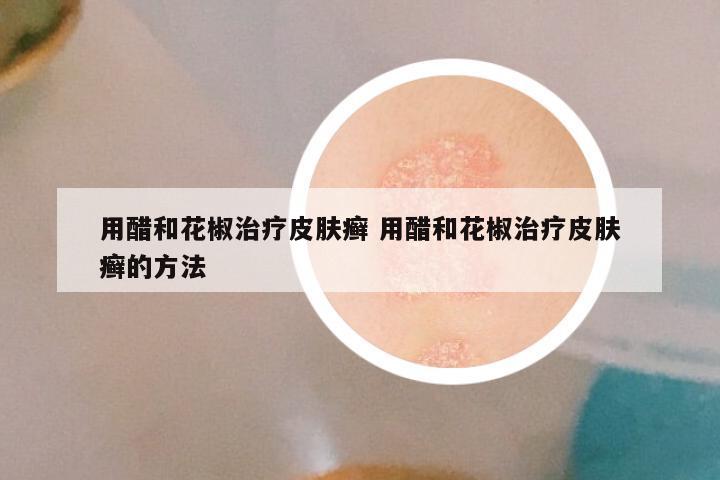 用醋和花椒治疗皮肤癣 用醋和花椒治疗皮肤癣的方法