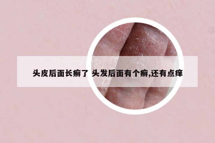 头皮后面长癣了 头发后面有个癣,还有点痒