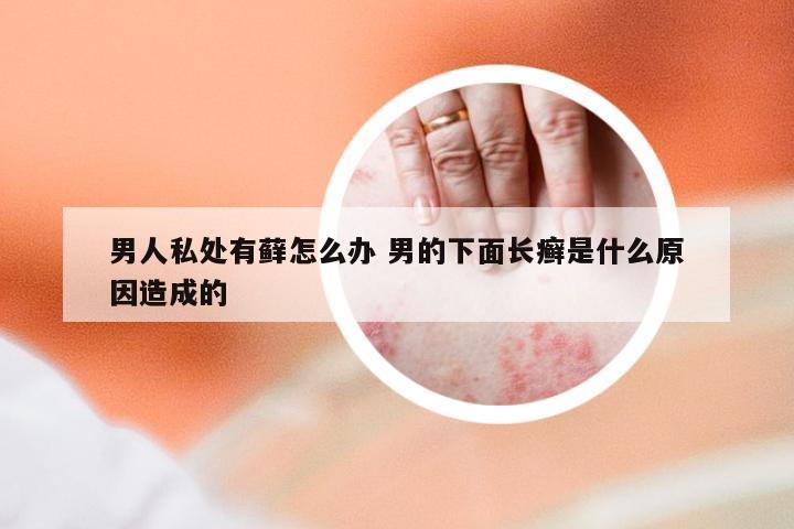 男人私处有藓怎么办 男的下面长癣是什么原因造成的