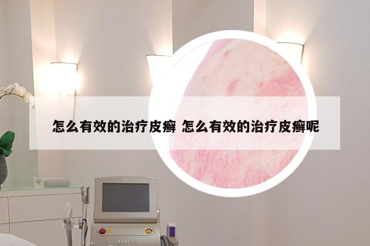 怎么有效的治疗皮癣 怎么有效的治疗皮癣呢