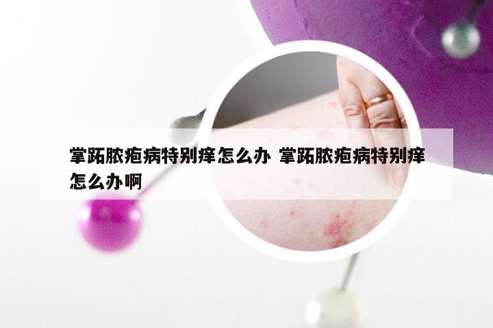掌跖脓疱病特别痒怎么办 掌跖脓疱病特别痒怎么办啊