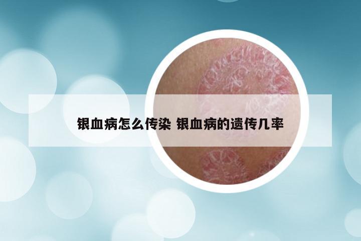 银血病怎么传染 银血病的遗传几率