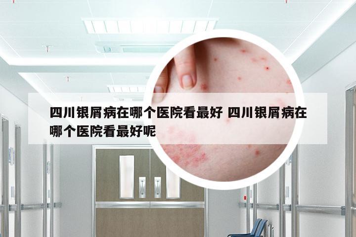 四川银屑病在哪个医院看最好 四川银屑病在哪个医院看最好呢