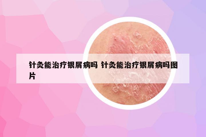 针灸能治疗银屑病吗 针灸能治疗银屑病吗图片