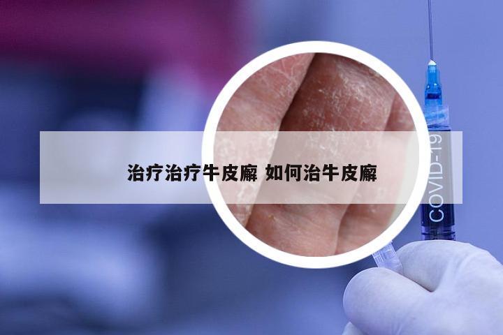 治疗治疗牛皮廨 如何治牛皮廨