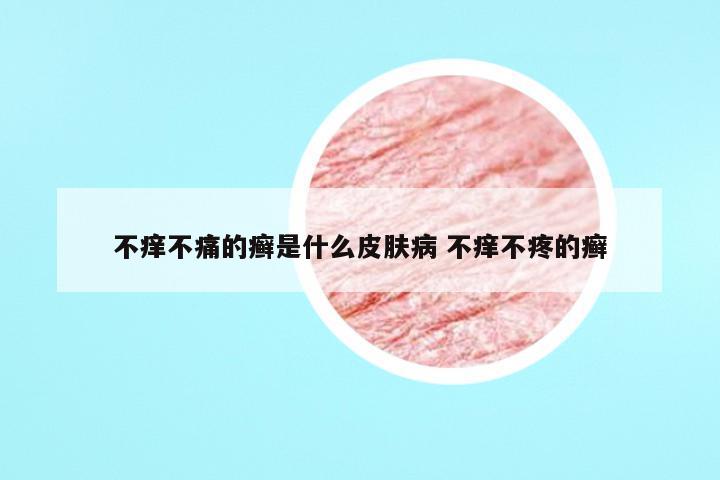 不痒不痛的癣是什么皮肤病 不痒不疼的癣