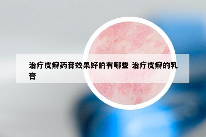 治疗皮癣药膏效果好的有哪些 治疗皮癣的乳膏