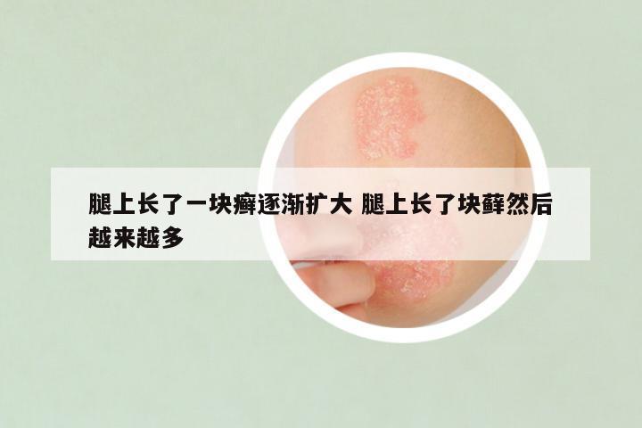 腿上长了一块癣逐渐扩大 腿上长了块藓然后越来越多