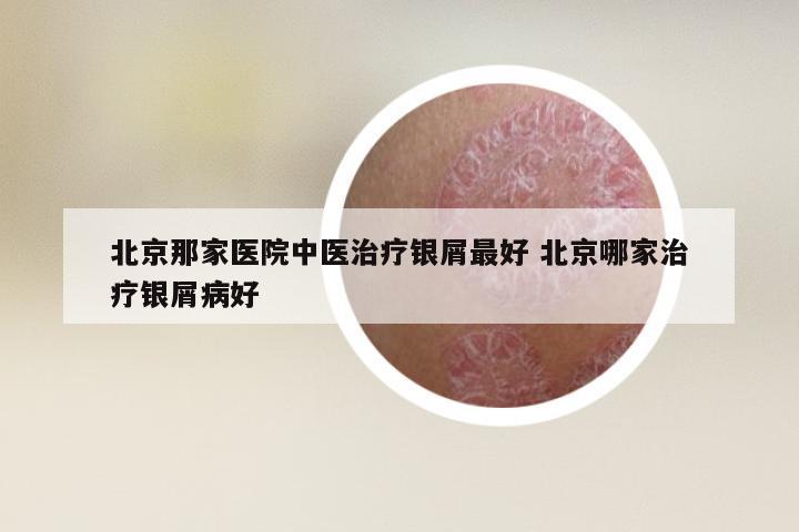 北京那家医院中医治疗银屑最好 北京哪家治疗银屑病好