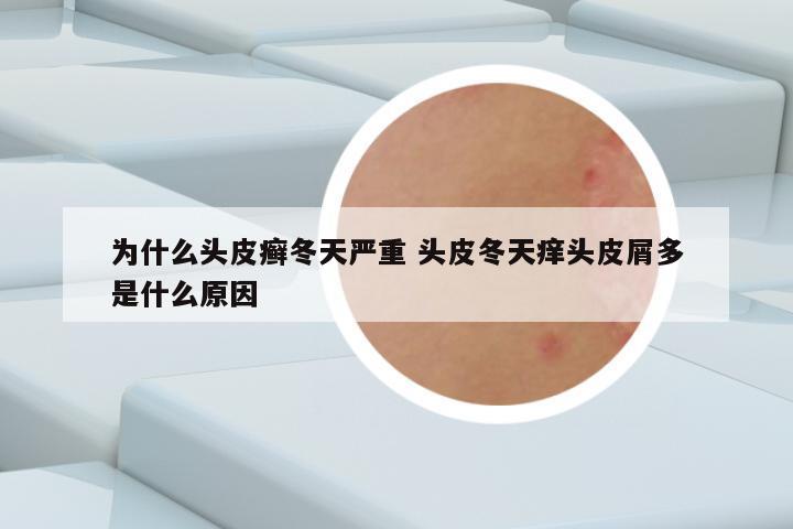 为什么头皮癣冬天严重 头皮冬天痒头皮屑多是什么原因