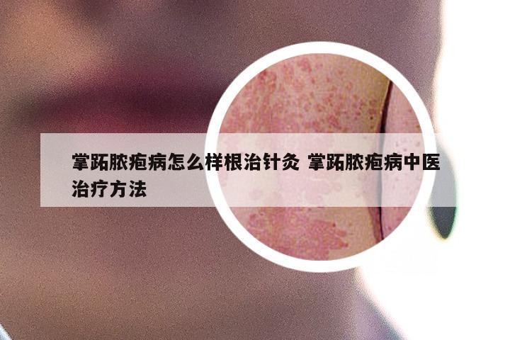 掌跖脓疱病怎么样根治针灸 掌跖脓疱病中医治疗方法