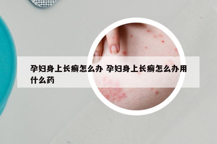 孕妇身上长癣怎么办 孕妇身上长癣怎么办用什么药