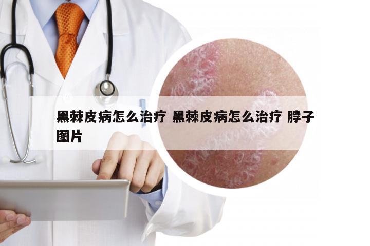黑棘皮病怎么治疗 黑棘皮病怎么治疗 脖子图片