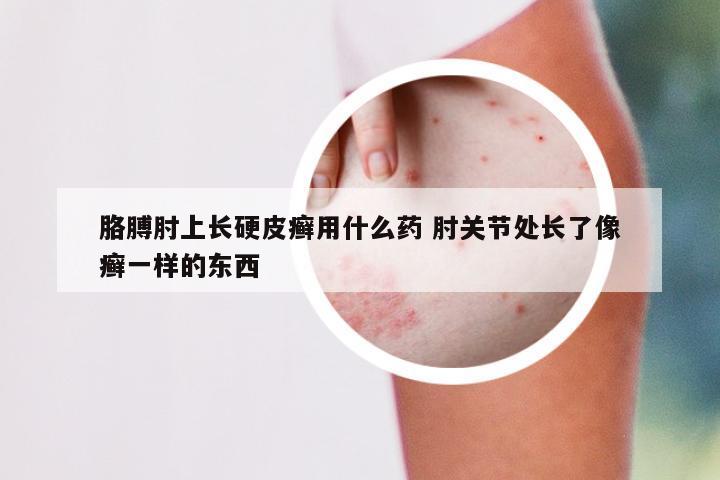 胳膊肘上长硬皮癣用什么药 肘关节处长了像癣一样的东西