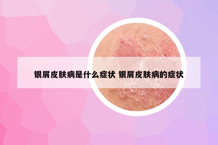 银屑皮肤病是什么症状 银屑皮肤病的症状