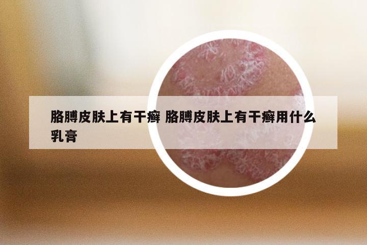 胳膊皮肤上有干癣 胳膊皮肤上有干癣用什么乳膏