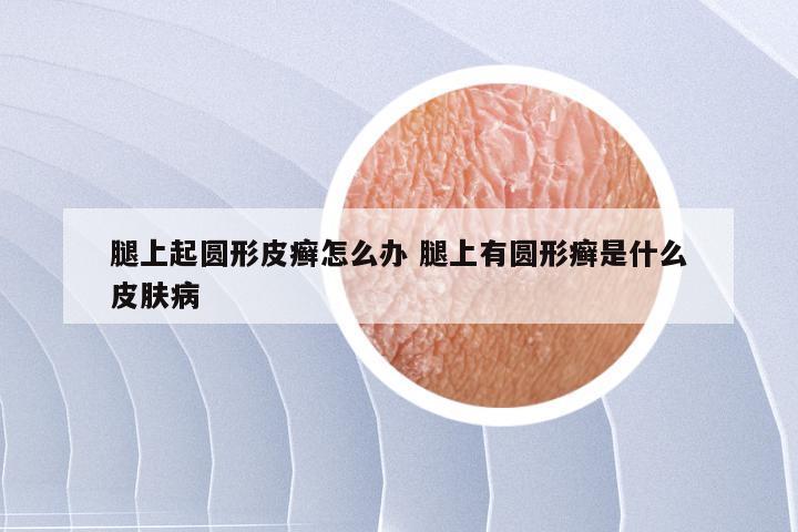 腿上起圆形皮癣怎么办 腿上有圆形癣是什么皮肤病