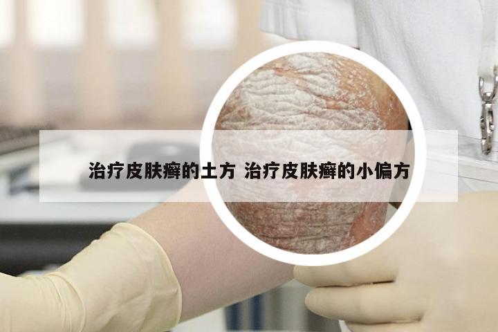治疗皮肤癣的土方 治疗皮肤癣的小偏方