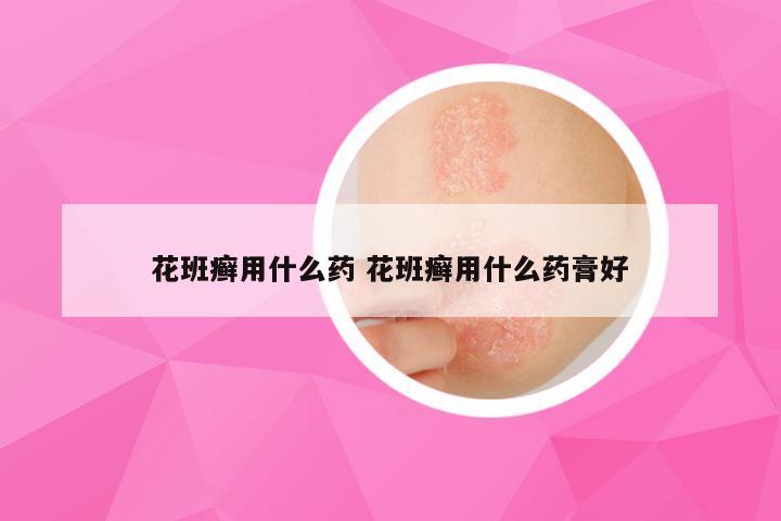 花班癣用什么药 花班癣用什么药膏好