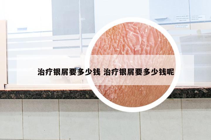 治疗银屑要多少钱 治疗银屑要多少钱呢