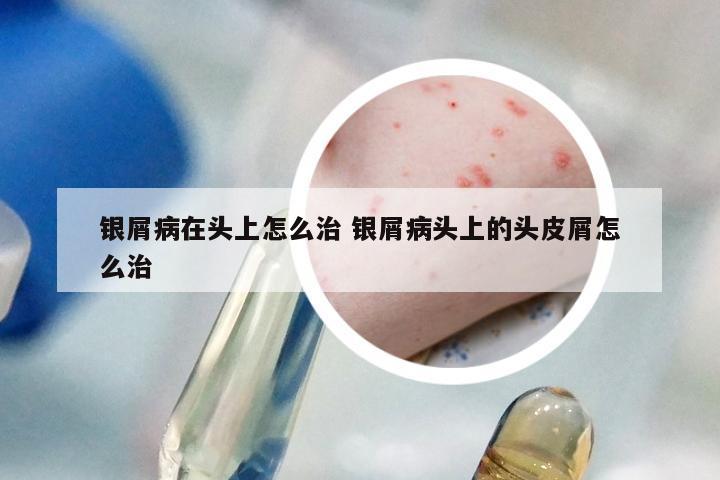 银屑病在头上怎么治 银屑病头上的头皮屑怎么治