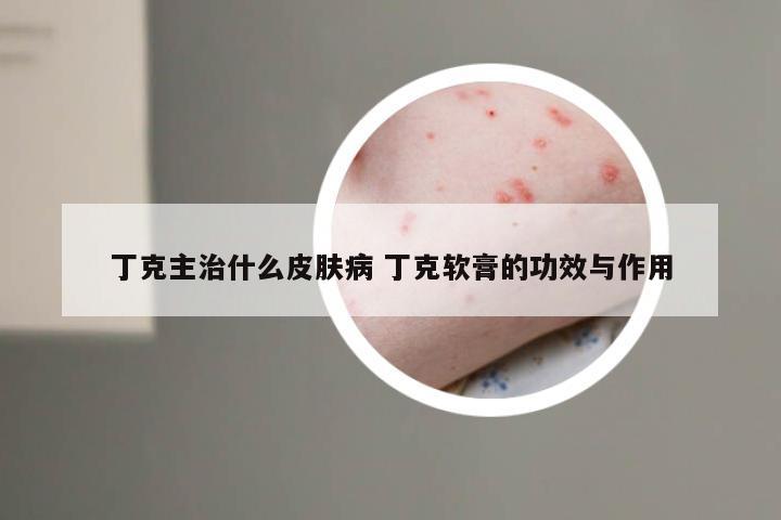 丁克主治什么皮肤病 丁克软膏的功效与作用