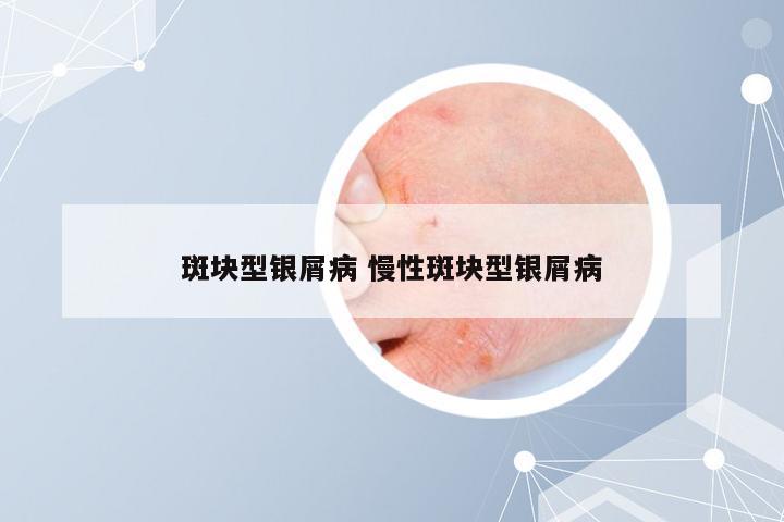 斑块型银屑病 慢性斑块型银屑病