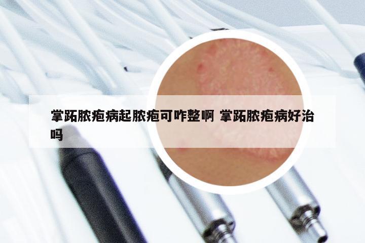 掌跖脓疱病起脓疱可咋整啊 掌跖脓疱病好治吗