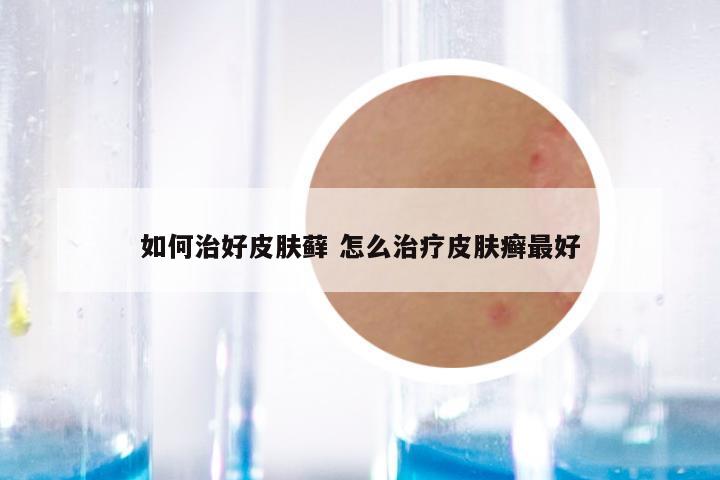 如何治好皮肤藓 怎么治疗皮肤癣最好