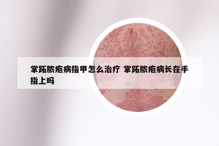 掌跖脓疱病指甲怎么治疗 掌跖脓疱病长在手指上吗