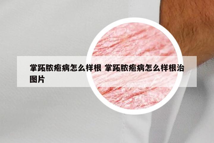 掌跖脓疱病怎么样根 掌跖脓疱病怎么样根治图片
