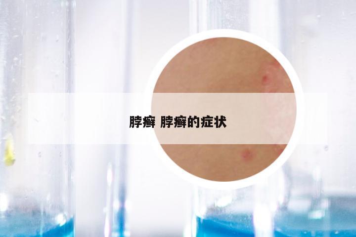 脖癣 脖癣的症状