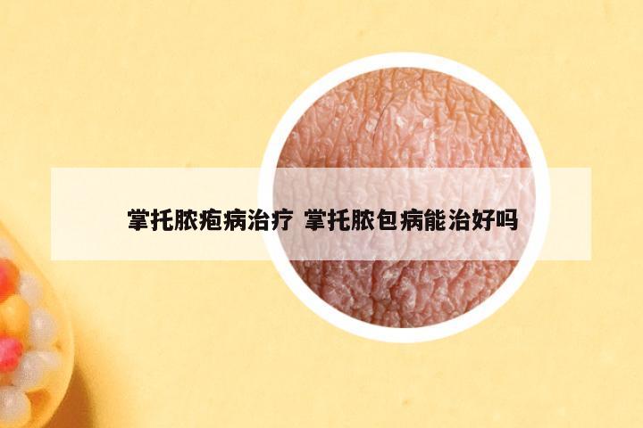 掌托脓疱病治疗 掌托脓包病能治好吗