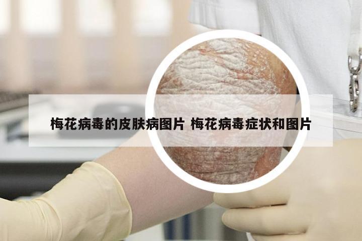梅花病毒的皮肤病图片 梅花病毒症状和图片