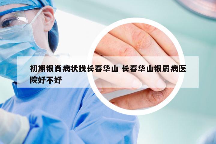 初期银肖病状找长春华山 长春华山银屑病医院好不好