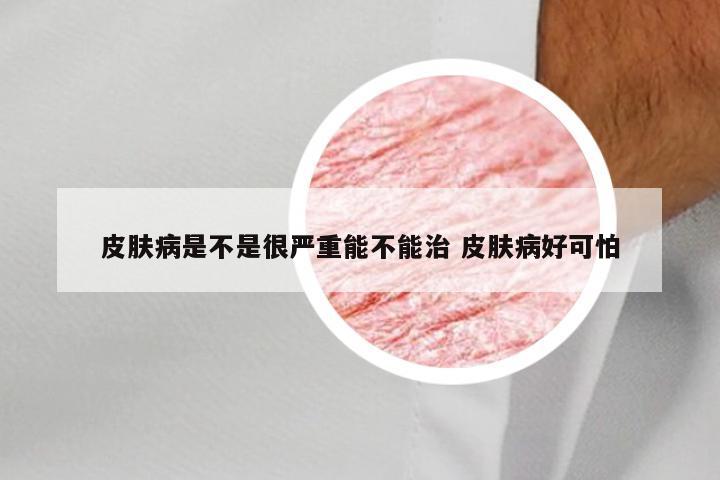 皮肤病是不是很严重能不能治 皮肤病好可怕