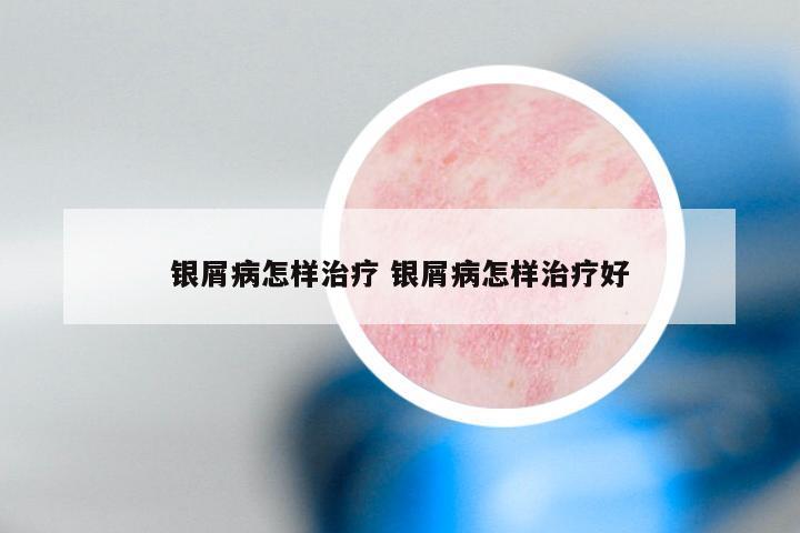 银屑病怎样治疗 银屑病怎样治疗好