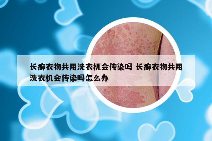 长癣衣物共用洗衣机会传染吗 长癣衣物共用洗衣机会传染吗怎么办