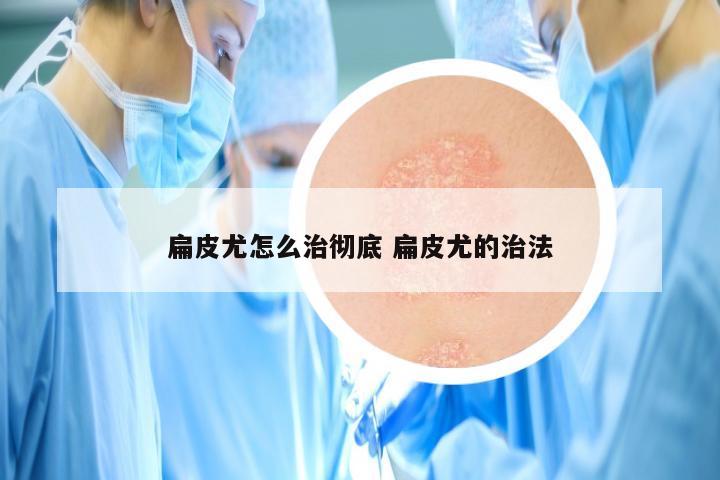 扁皮尤怎么治彻底 扁皮尤的治法