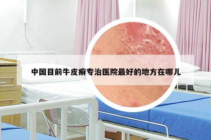 中国目前牛皮癣专治医院最好的地方在哪儿