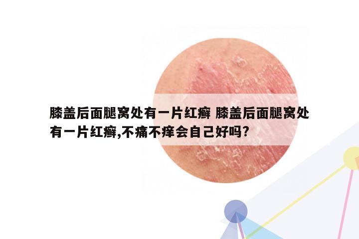 膝盖后面腿窝处有一片红癣 膝盖后面腿窝处有一片红癣,不痛不痒会自己好吗?